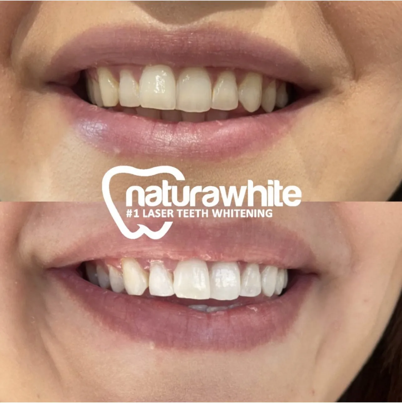 28866 teeth whitening cost