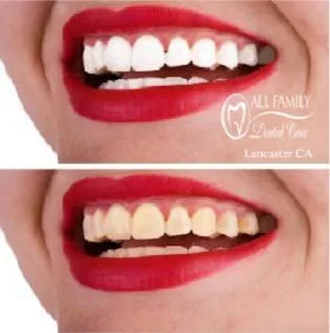 28873 at home teeth whitening kits