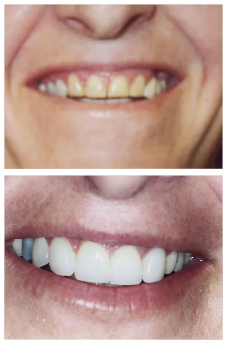 28873 professional teeth whitening