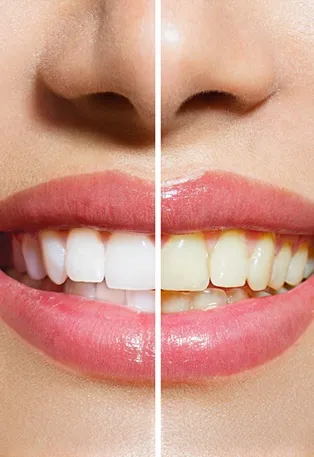 28873 teeth whitening lancaster before after