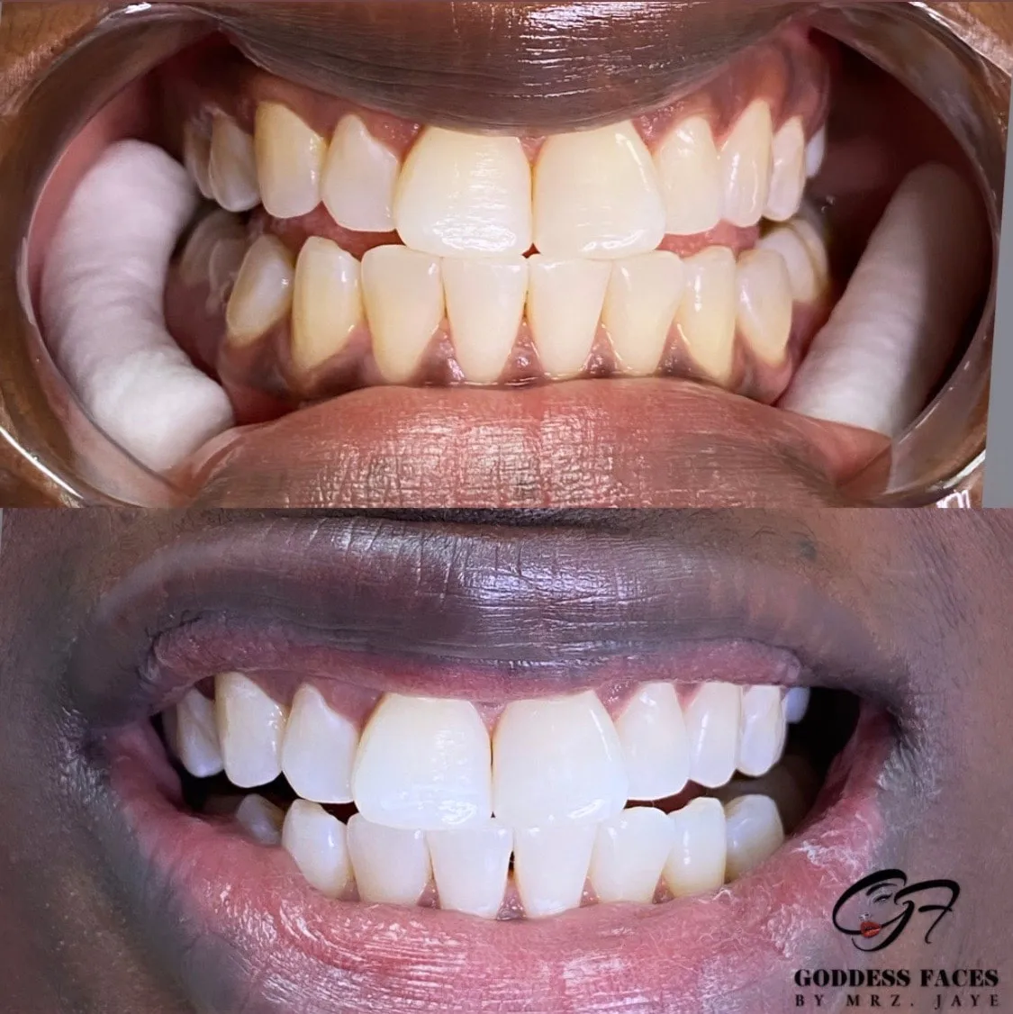 /img/28874-Edina-teeth-whitening-results.webp