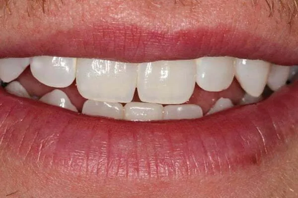 28874 teeth whitening diet