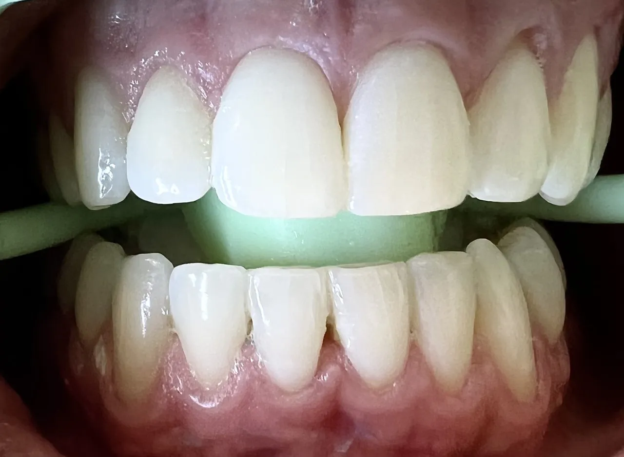 28876 polished whitening before after