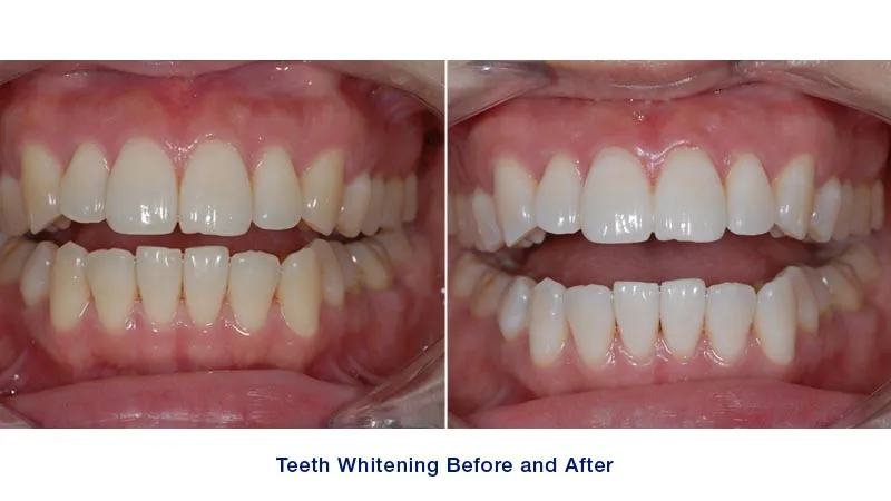 28881 at home teeth whitening kits