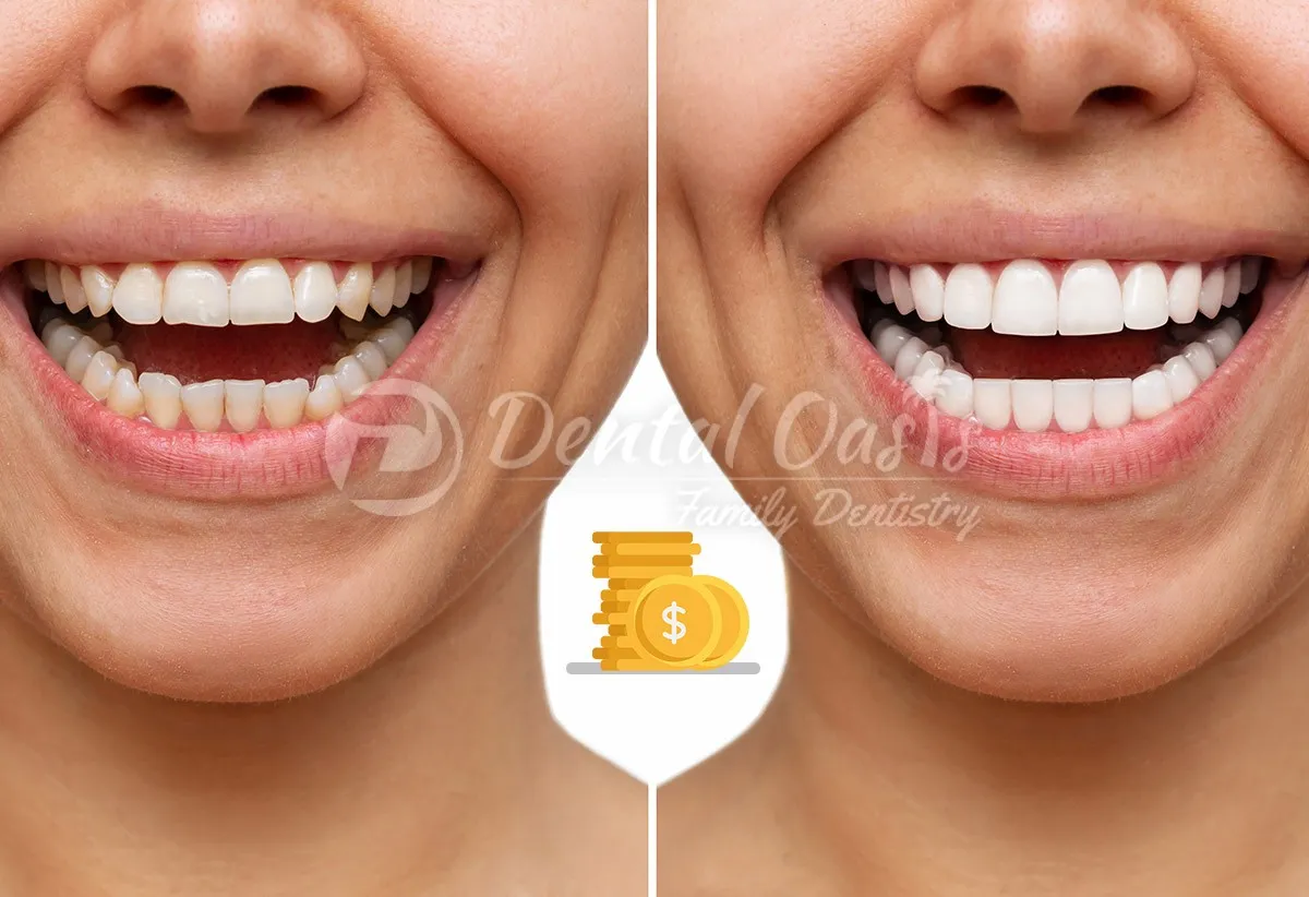 28881 in office teeth whitening