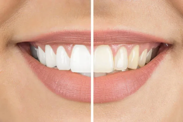 28881 teeth whitening trinidad