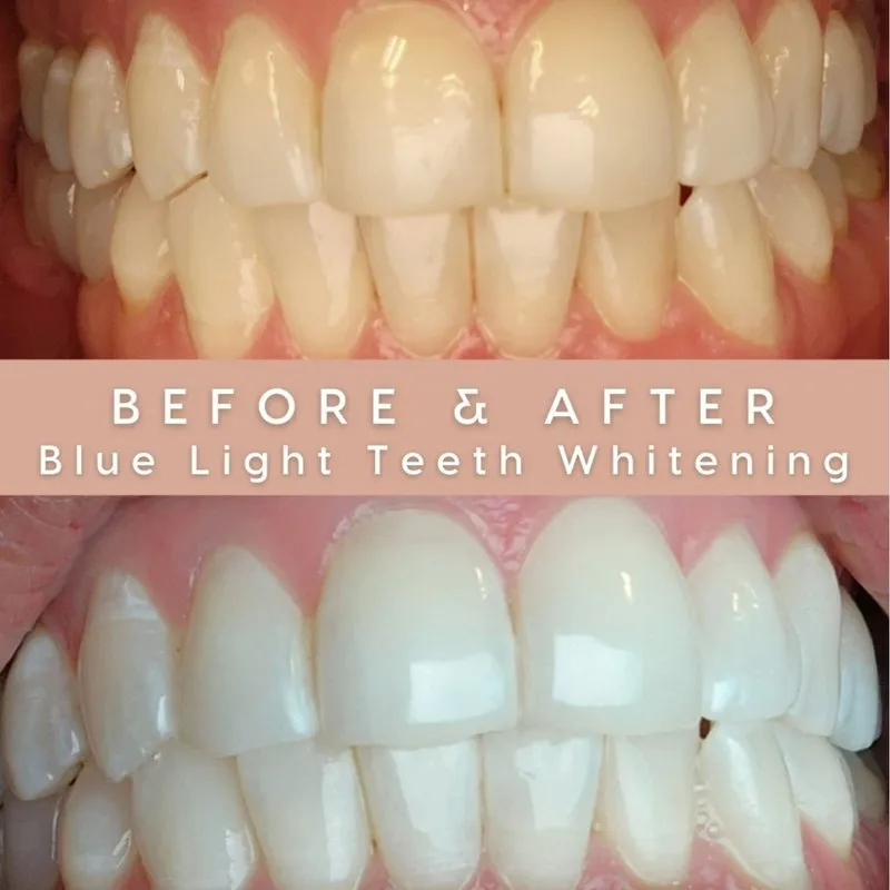 28882 teeth whitening procedure