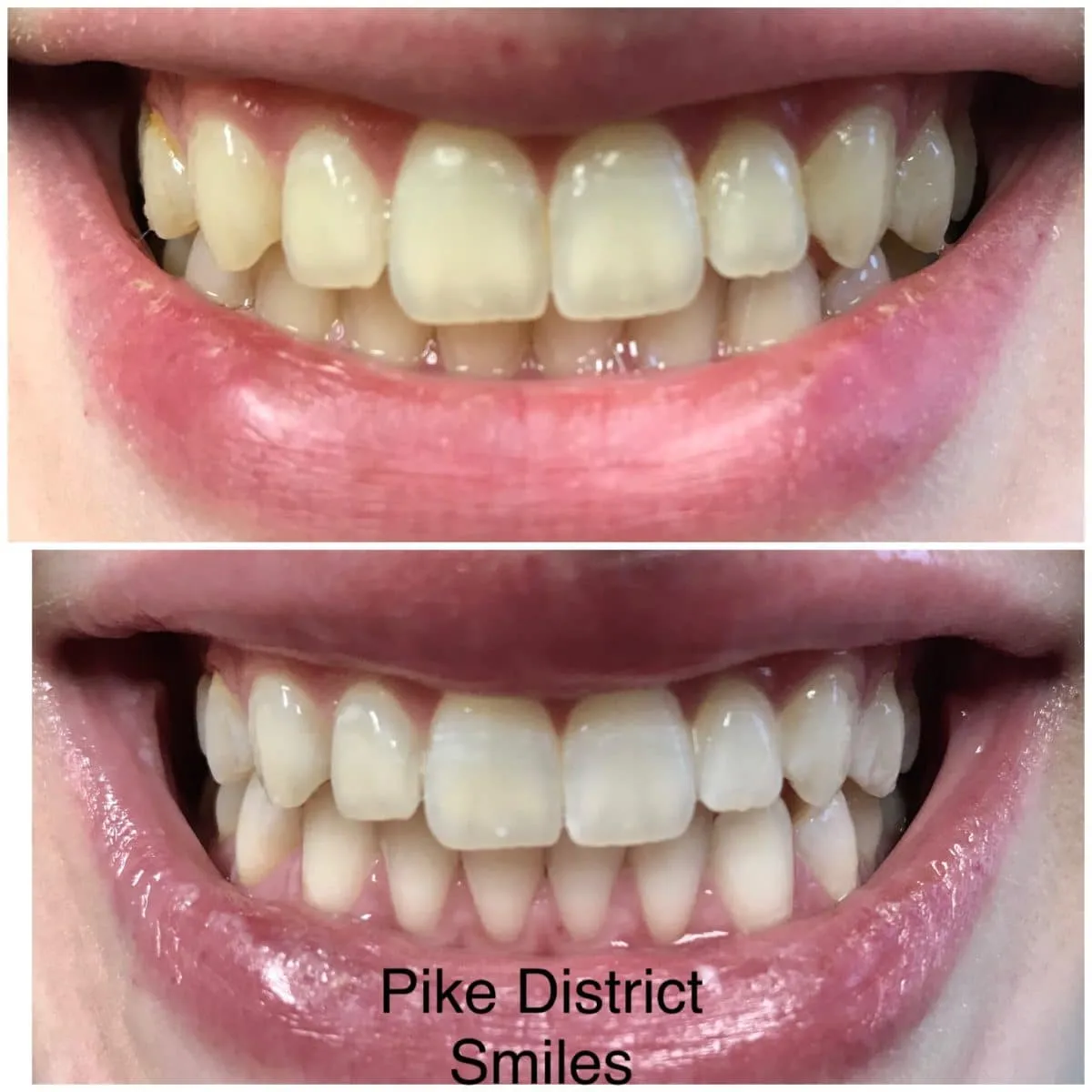 28885 teeth whitening maryland smiling
