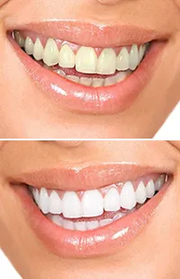 /img/28885-teeth-whitening-sensitivity.webp