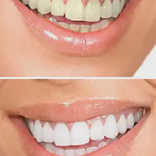 /img/28885-teeth-whitening-sensitivity.webp