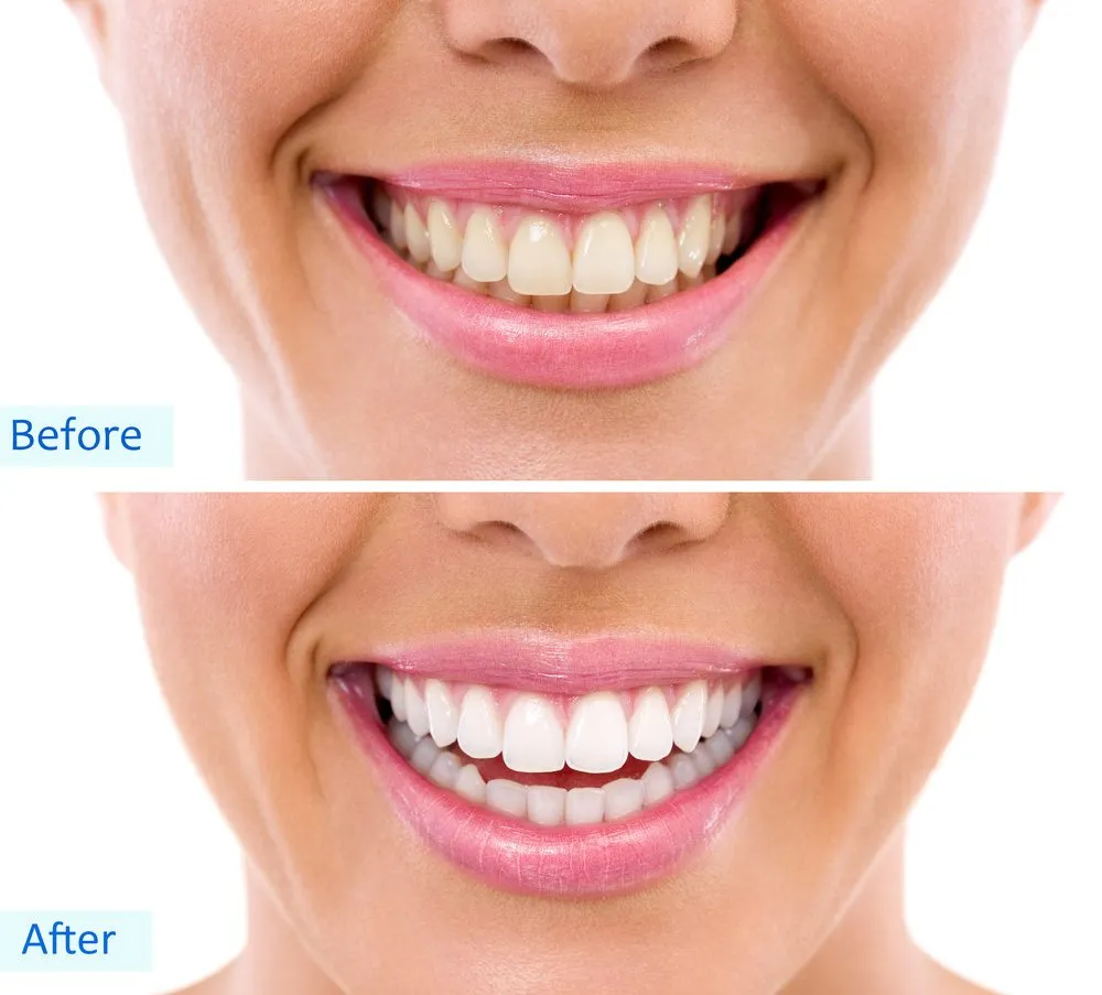 28887 teeth whitening insurance