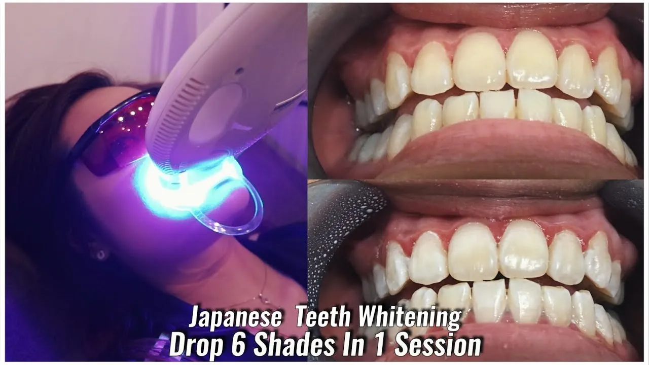 28889 teeth whitening strips