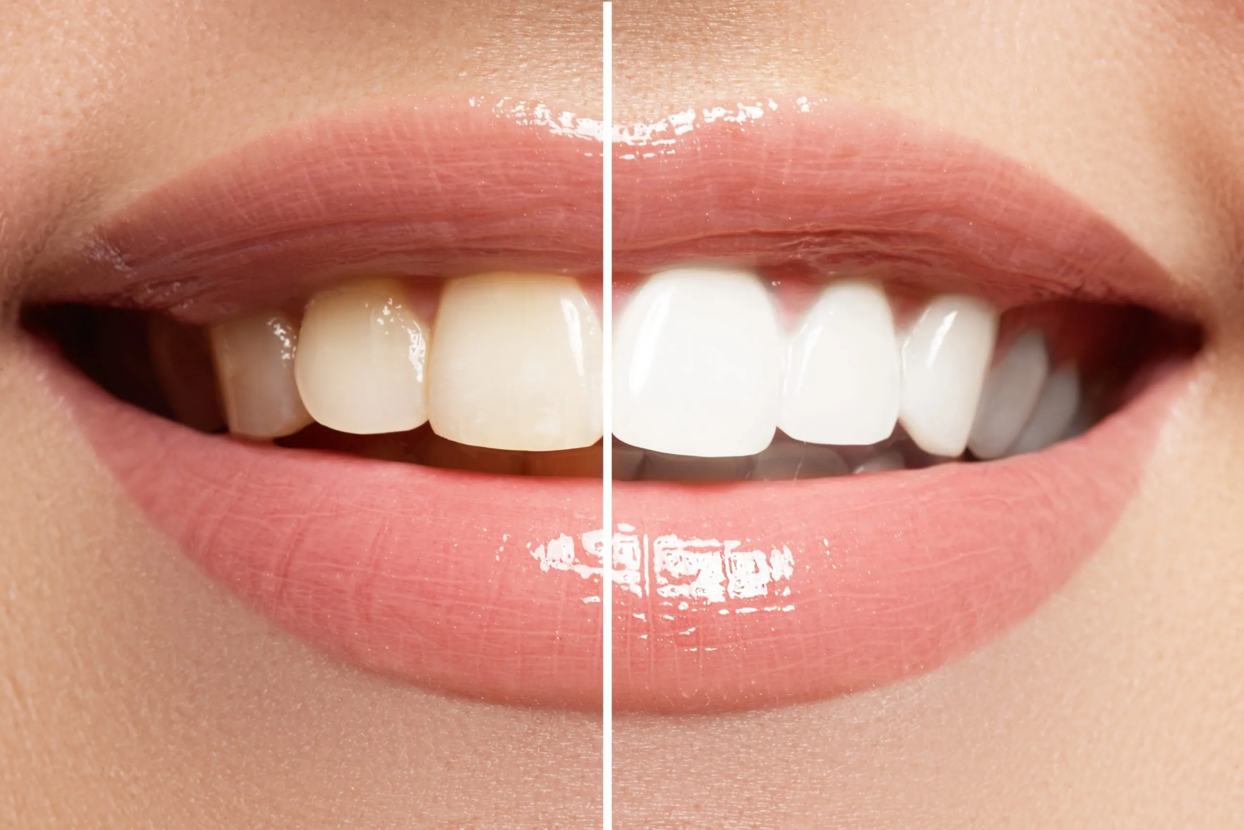28893 in office teeth whitening