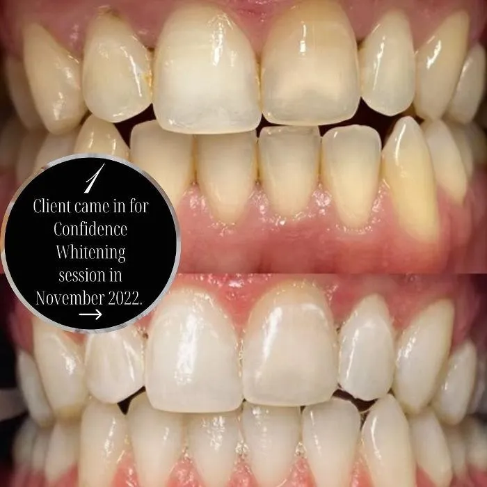 28893 teeth whitening benefits