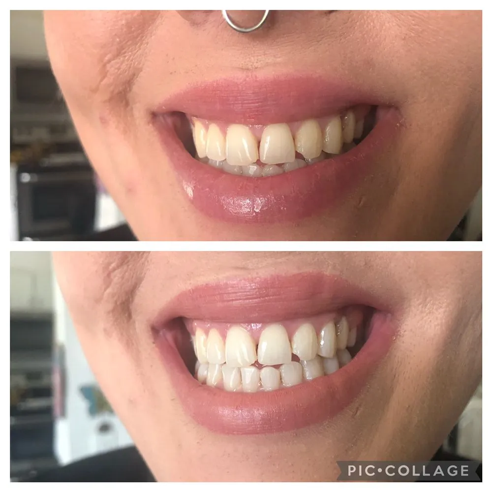 28900 teeth whitening spokane wa image1