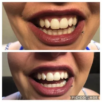 28900 teeth whitening spokane wa image3
