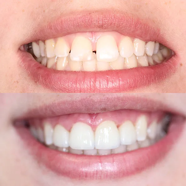 28900 teeth whitening spokane wa image4