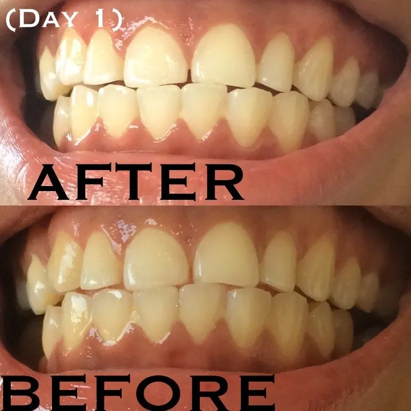 28903 teeth whitening process