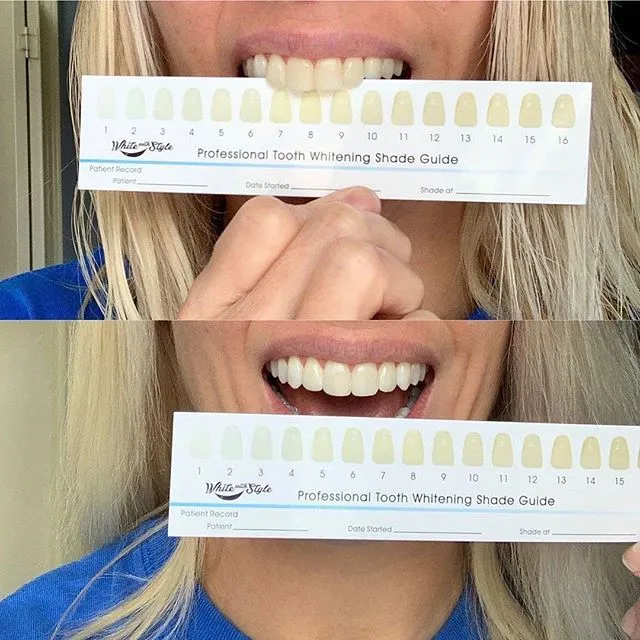 28903 teeth whitening results