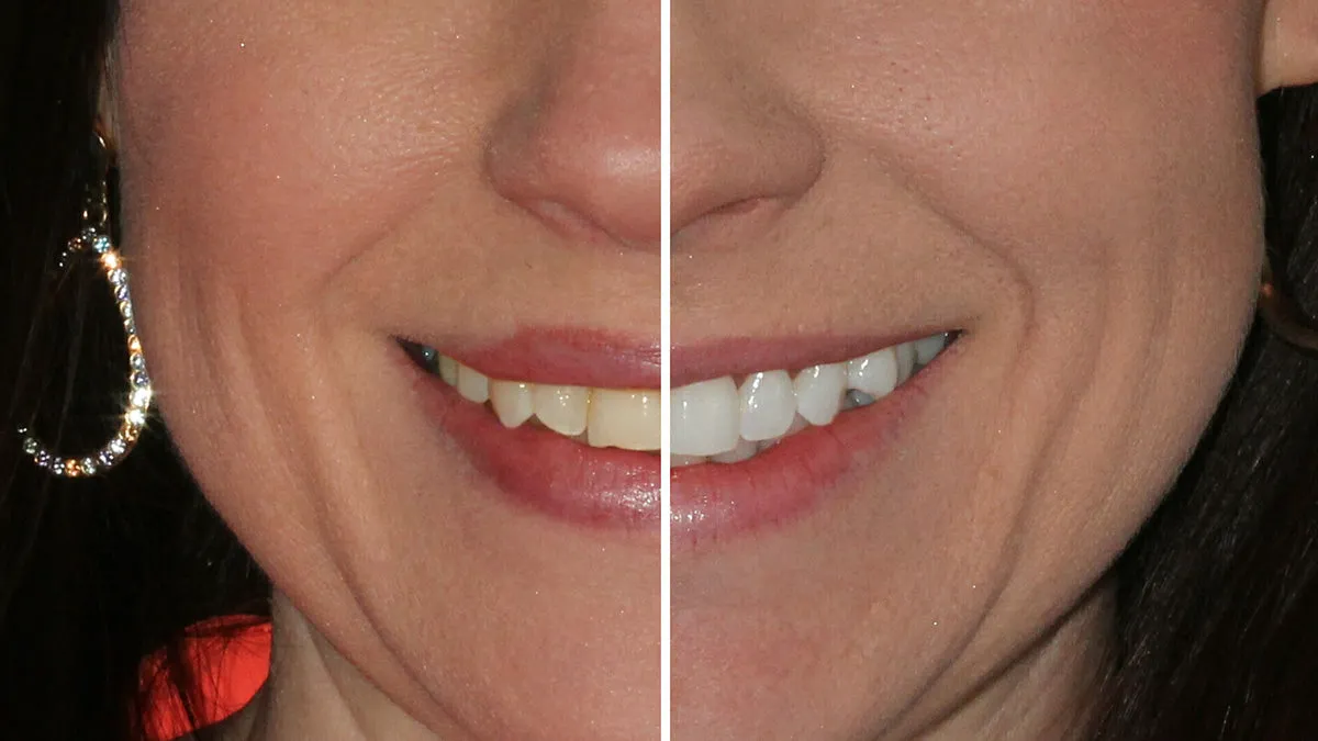 28909 affordable teeth whitening