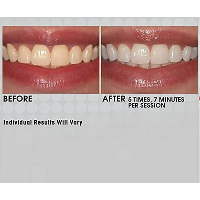 28909 before after intelliwhite