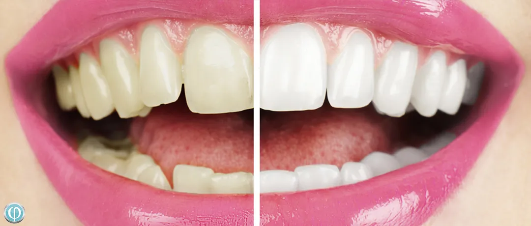 28912 teeth whitening aftercare