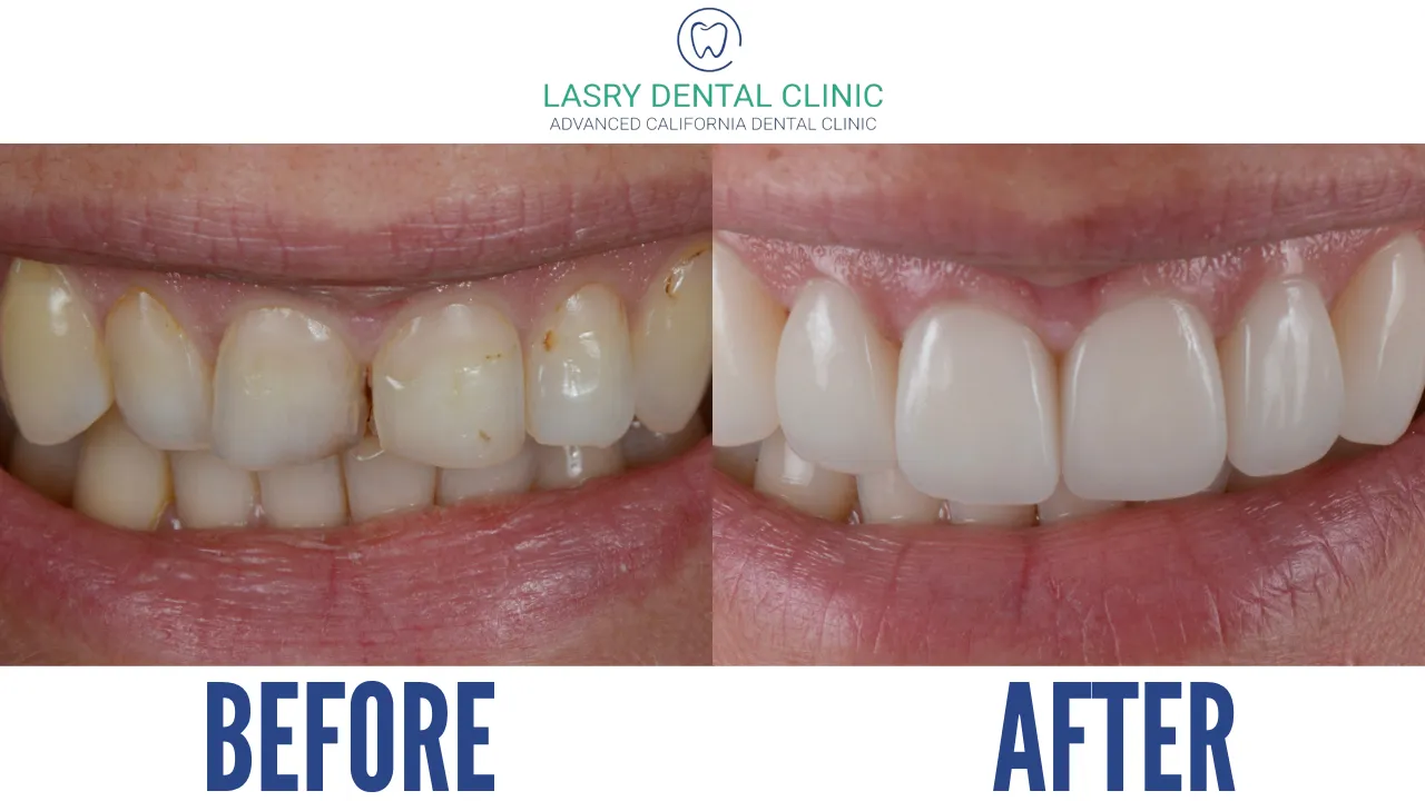 28912 zoom whitening pain scale