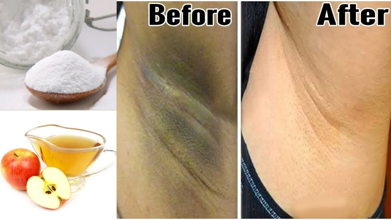 28913 underarms whitening before after