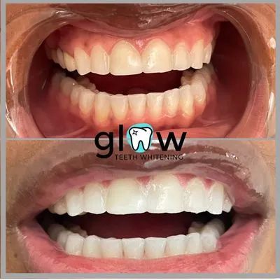 28914 oklahoma city tooth whitening at home