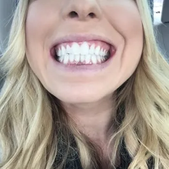 28914 oklahoma city tooth whitening options