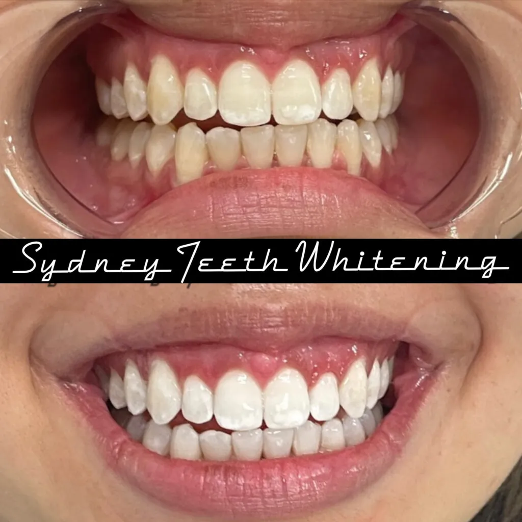 28915 professional teeth whitening