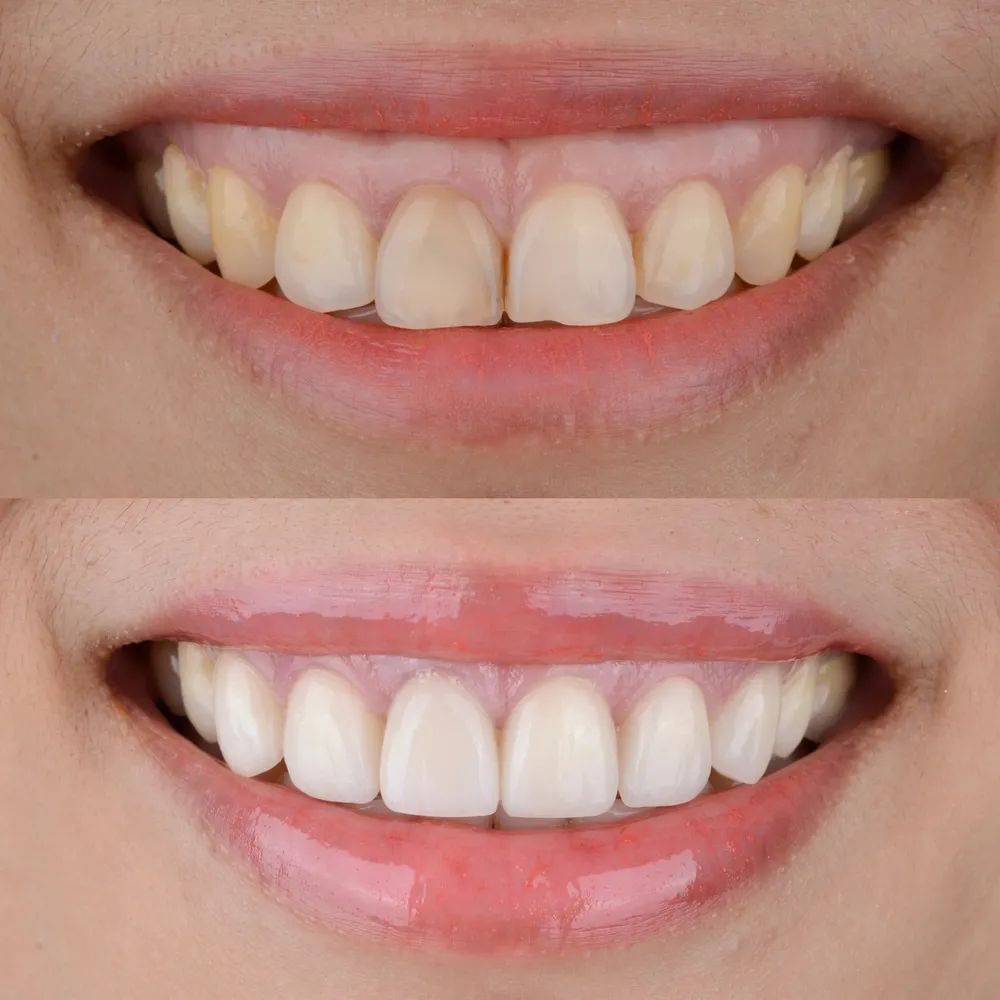 28915 teeth whitening joliet basics