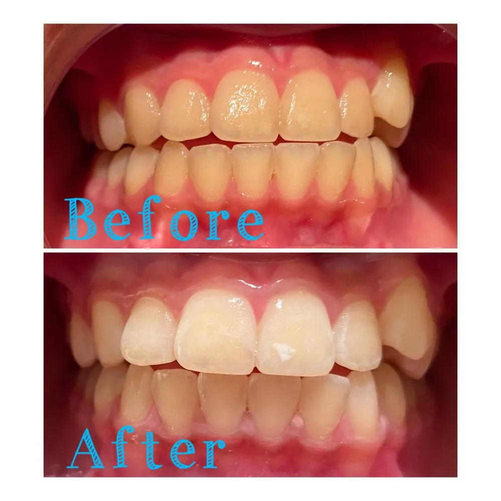 28920 teeth whitening boost confidence