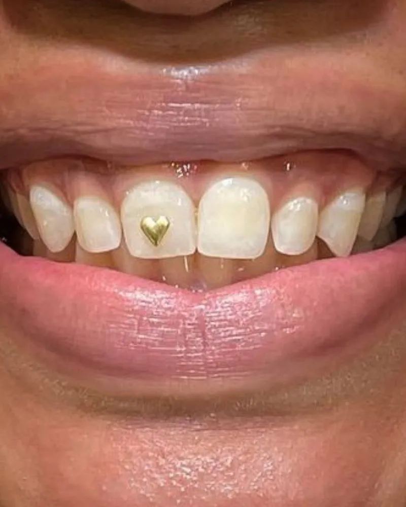 28920 teeth whitening fast results