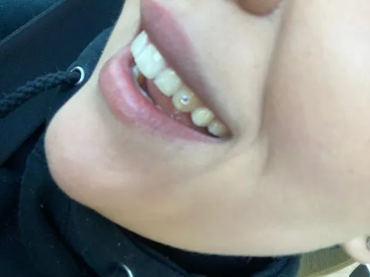 28920 teeth whitening improved appearance