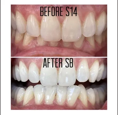 28920 teeth whitening santa cruz overview
