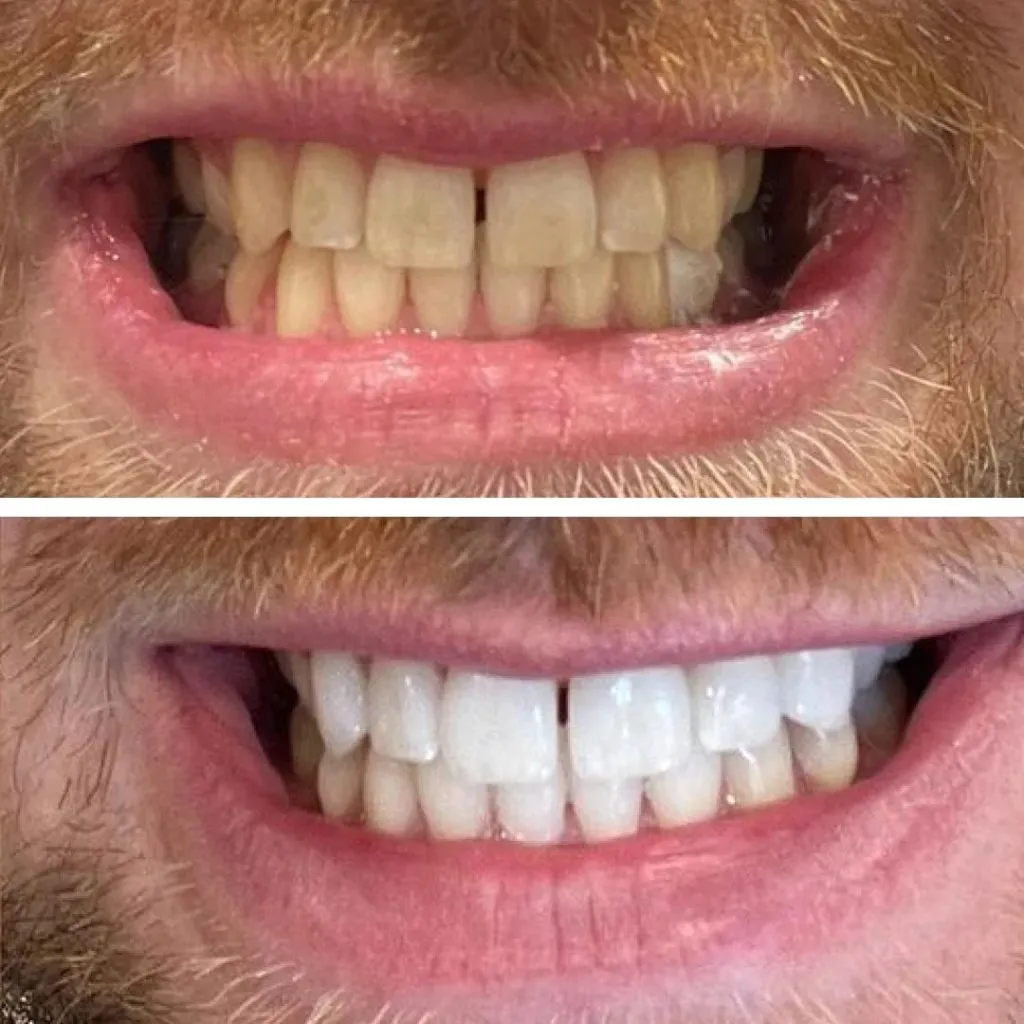 28922 at home teeth whitening