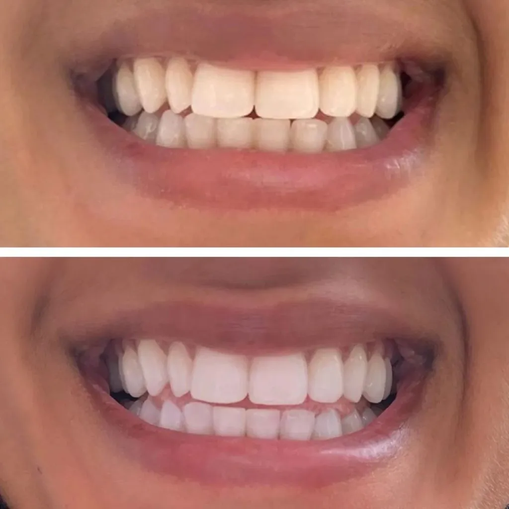 28922 professional teeth whitening
