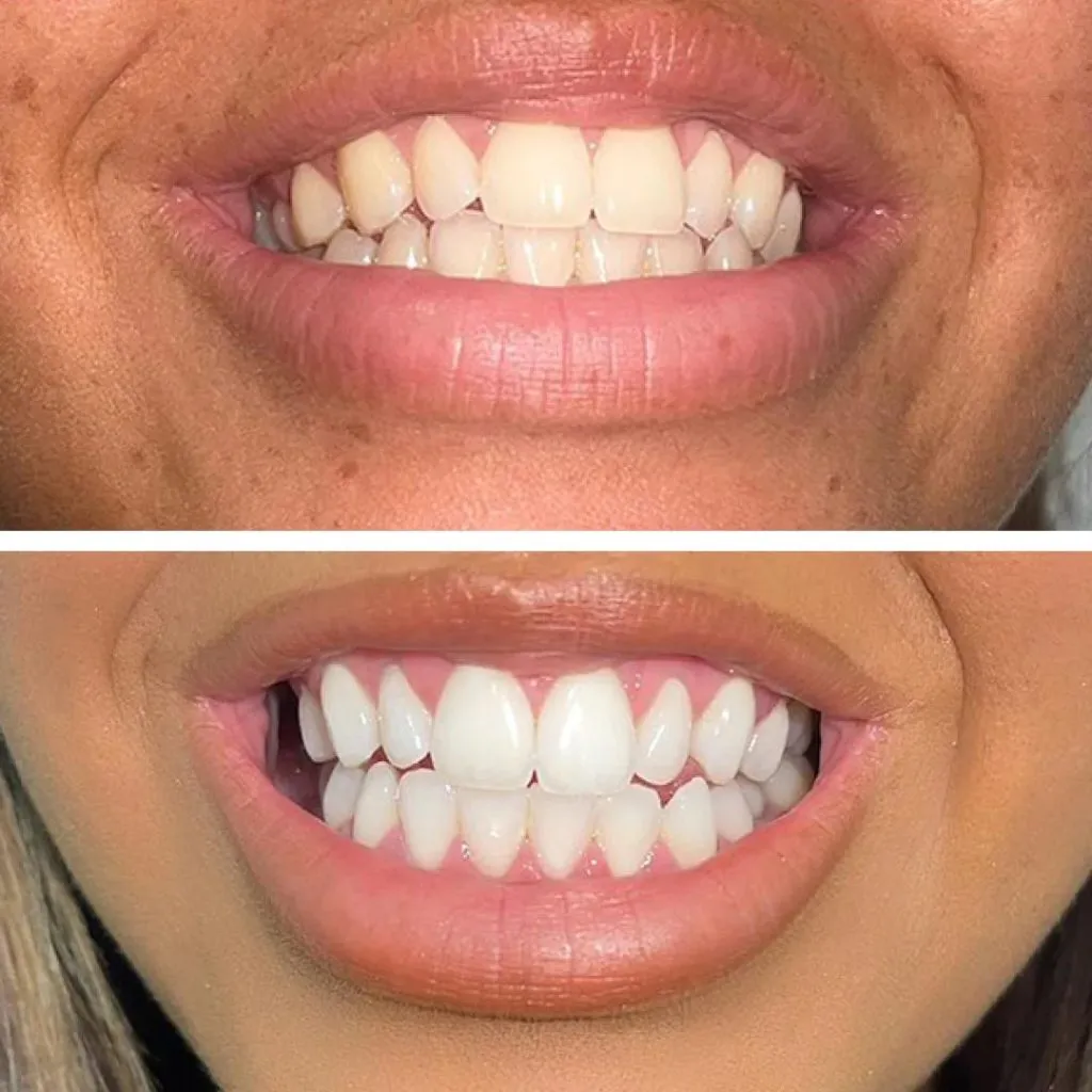 28922 teeth whitening overview