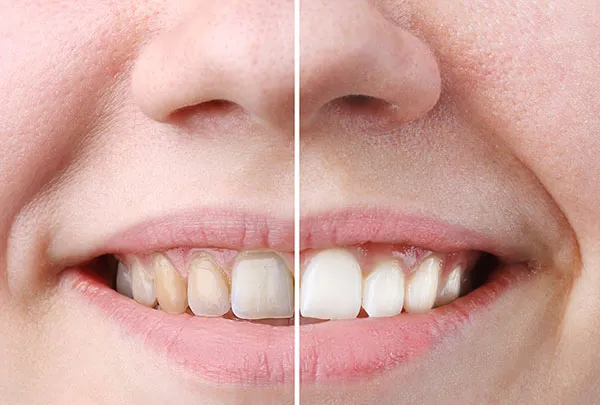 28923 teeth whitening somerset confident smile