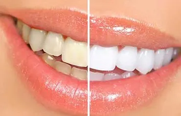 28923 teeth whitening somerset healthy gums