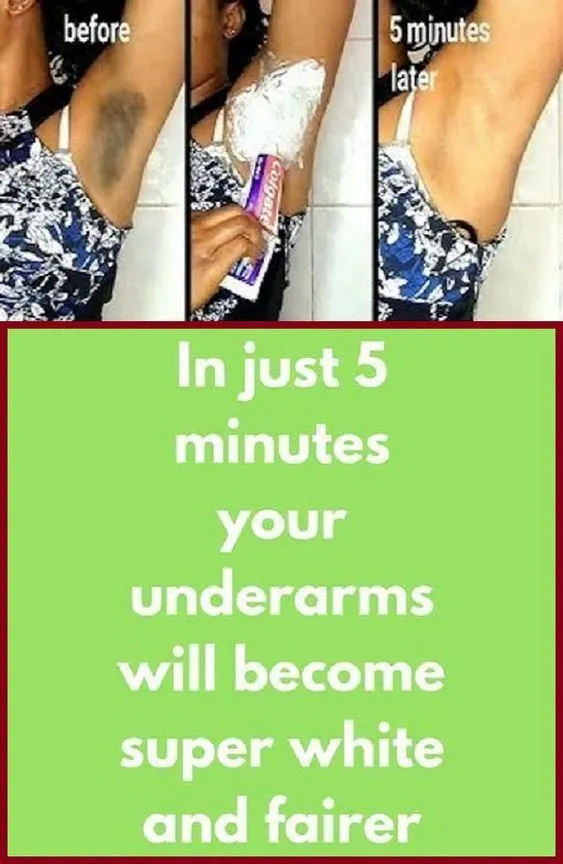 28926 dark underarms hyperpigmentation