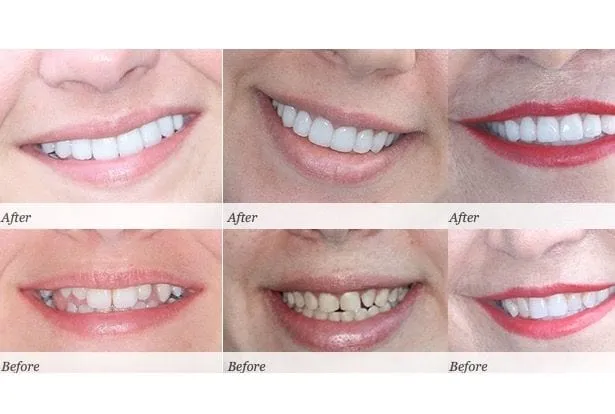 28929 teeth whitening results