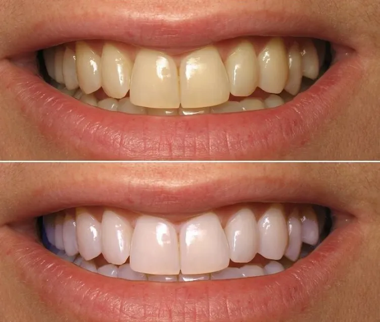 28930 hydrogen peroxide in whitening strips