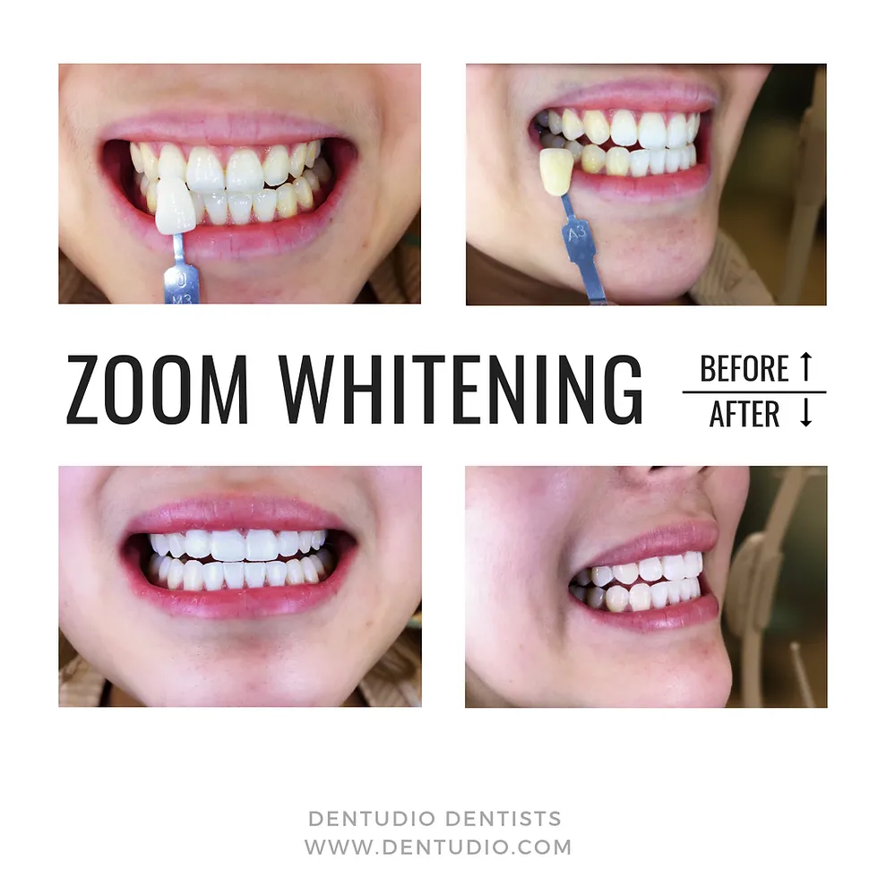 /img/28934-zoom-whitening-benefits.webp