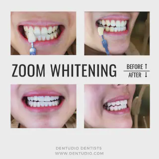 /img/28934-zoom-whitening-benefits.webp