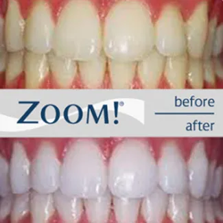 28934 zoom whitening consultation
