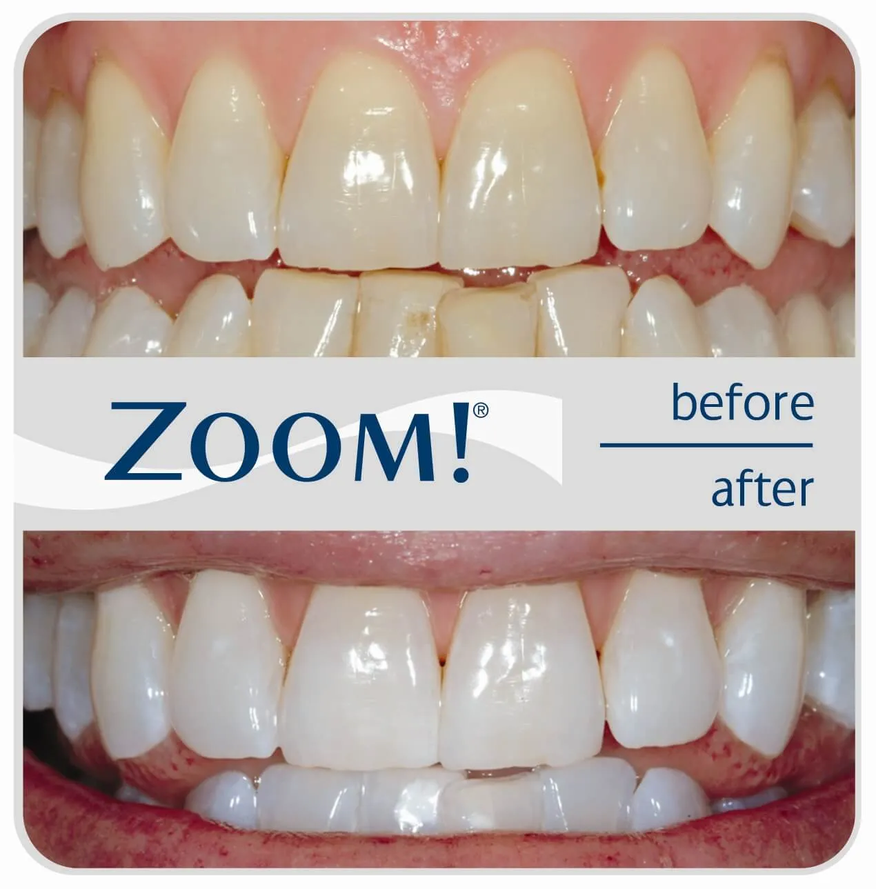 28934 zoom whitening procedure