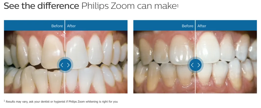 28934 zoom whitening sensitivity