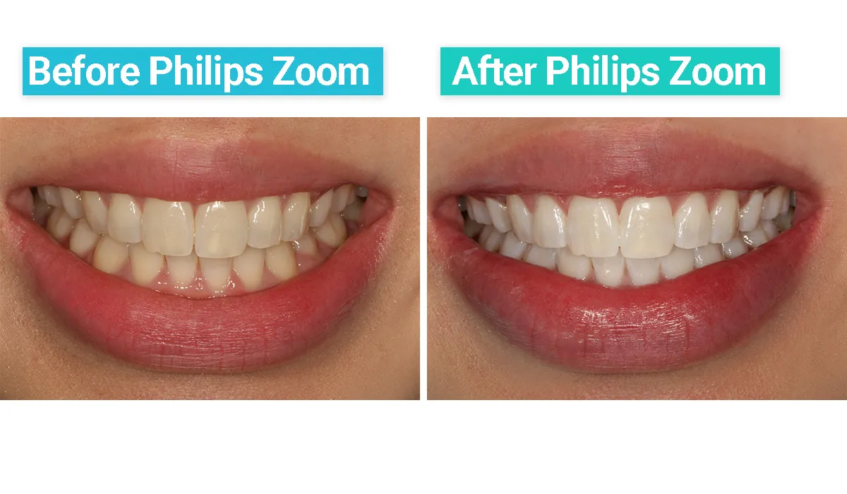 28934 zoom whitening smile